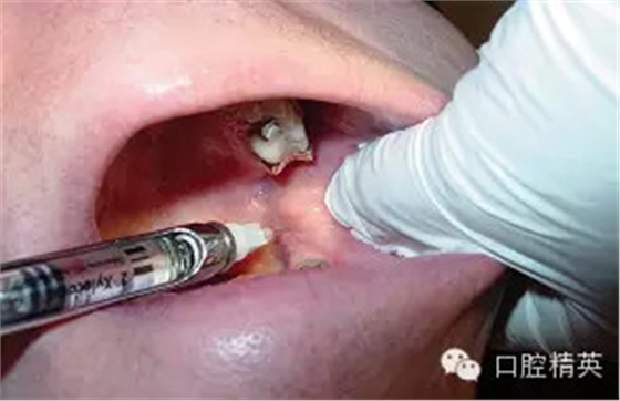 口腔局部麻醉并發癥及臨床處理