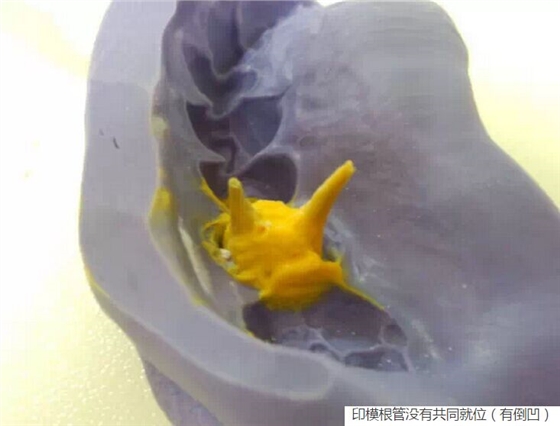 氧化鋯樁核后牙根管有倒凹設計