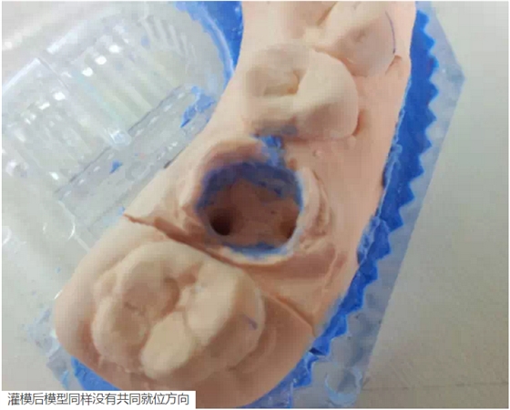 氧化鋯樁核后牙根管有倒凹設計