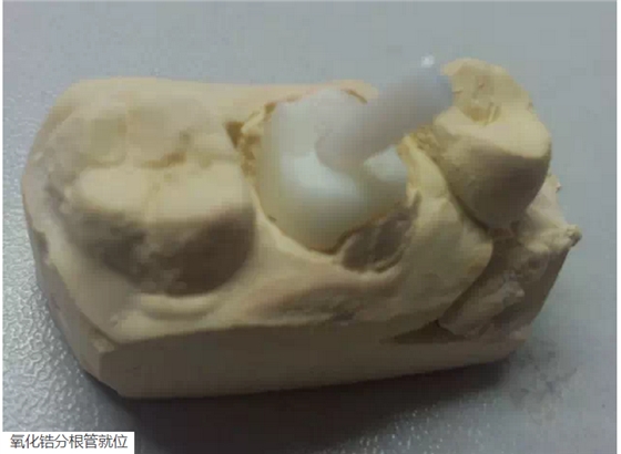 氧化鋯樁核后牙根管有倒凹設計
