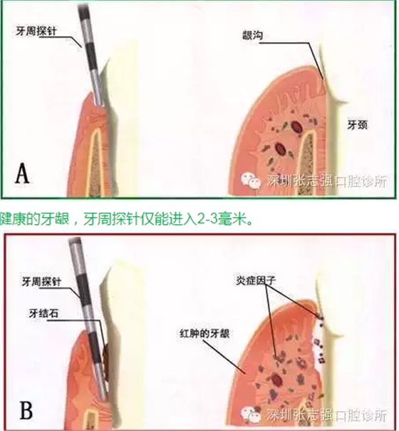 刷牙出血，牙齦紅腫，并非缺乏維生素