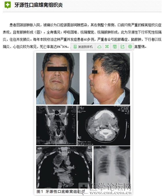 口腔疾病與全身系統性疾病的關系