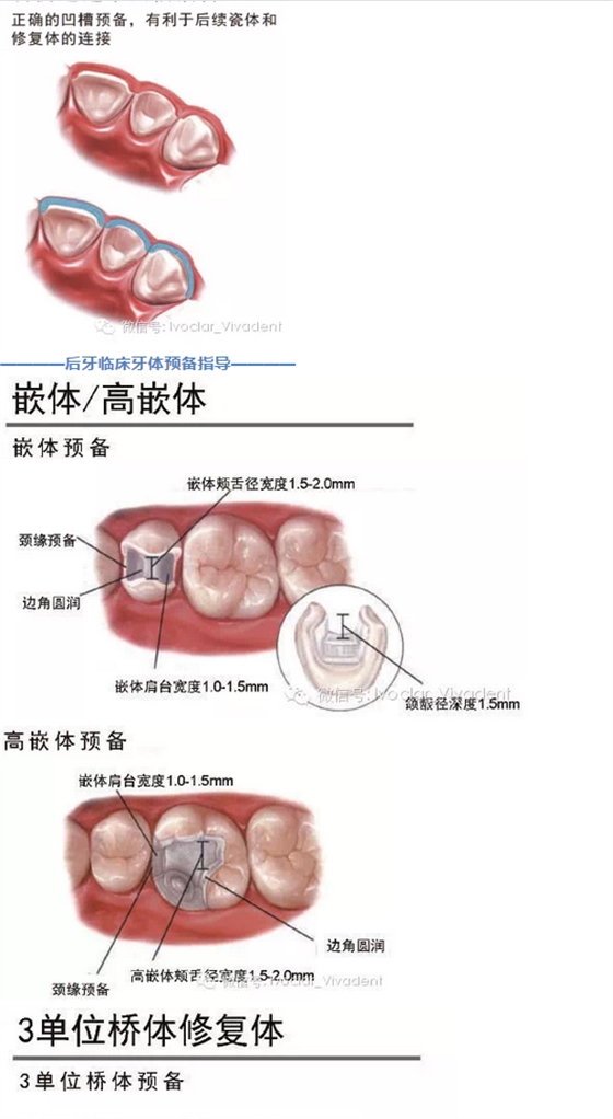 時(shí)常搞不清楚怎么備牙嗎？義獲嘉教您如何完美備牙