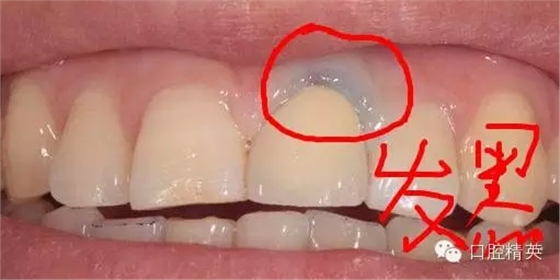 為什么牙醫叫您做二氧化鋯