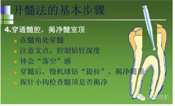 開髓術
