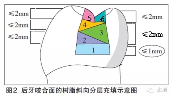 陳智：后牙復合樹脂修復技術概述