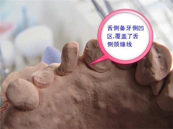 口腔修復醫生備牙取摸常見問題系列之——基牙倒凹 與 備牙時“就位道”的處理