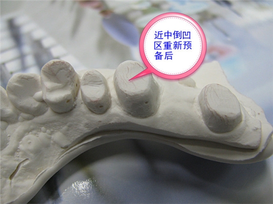 口腔修復醫生備牙取摸常見問題系列之——基牙倒凹 與 備牙時“就位道”的處理
