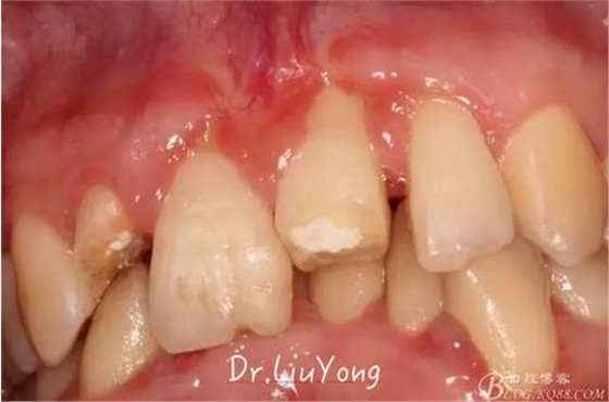 山西牙周劉勇：“前牙外傷患者的口腔多學科聯合治療”精彩案例分享