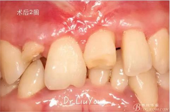 山西牙周劉勇：“前牙外傷患者的口腔多學科聯合治療”精彩案例分享