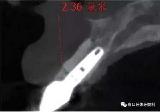 右上前牙即刻種植即刻修復1例