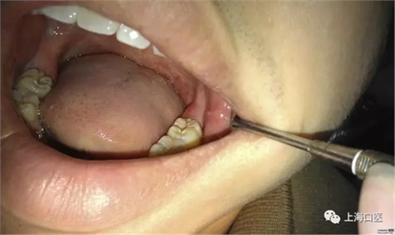 拔牙干槽癥可怕嗎？