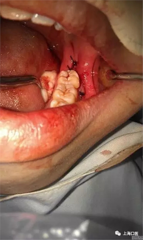 拔牙干槽癥可怕嗎？
