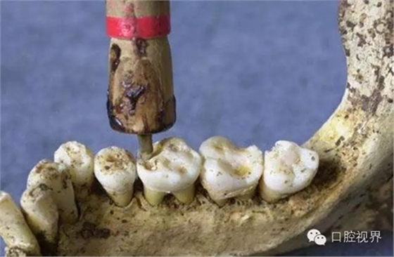以前牙醫是怎樣虐待人們牙齒的？ 看完了就知道現在看牙多舒適了！