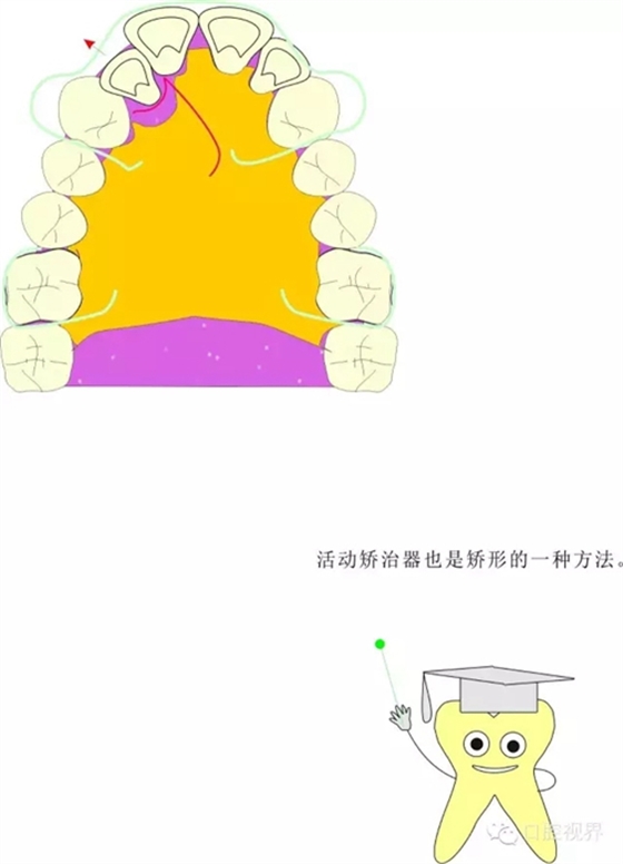 【愛(ài)牙科普知識(shí)300問(wèn)】 “什么是頜（牙）墊？”