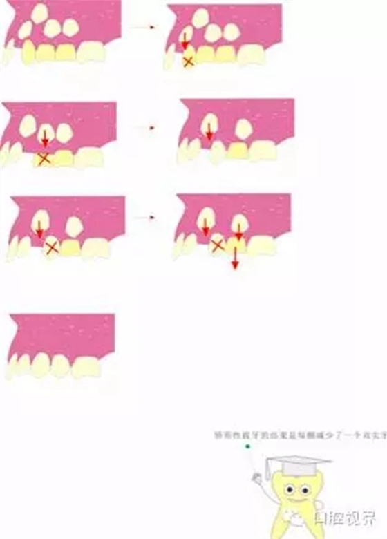  “什么是牙周袋沖洗？”