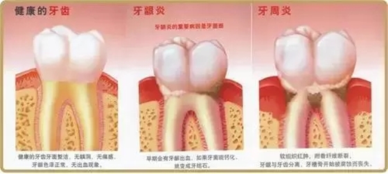 【康雅愛牙科普】牙周炎危害這么大，你咋還不著急呢？