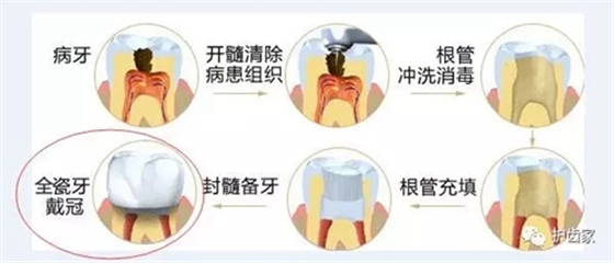 根管治療后，可以不做烤瓷牙嗎？