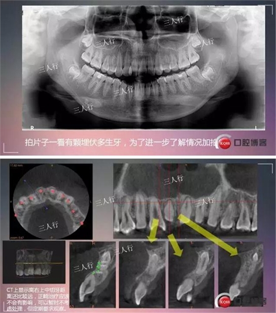 深部埋伏多生牙——微創處理  