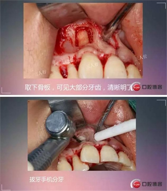 深部埋伏多生牙——微創處理  
