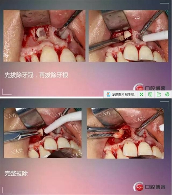 深部埋伏多生牙——微創處理  