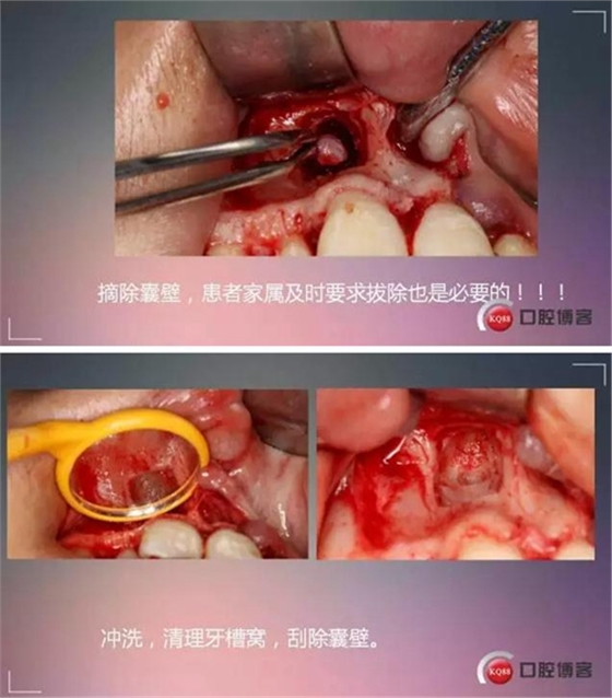 深部埋伏多生牙——微創處理  