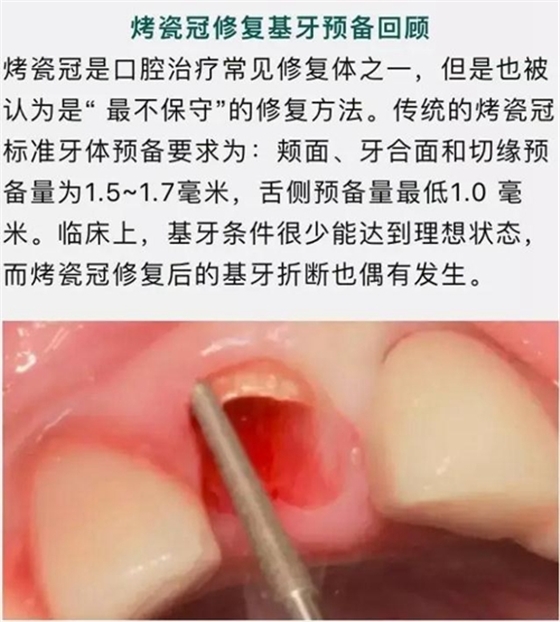 做全冠修復(fù)時基牙根面暴露，如何備牙？