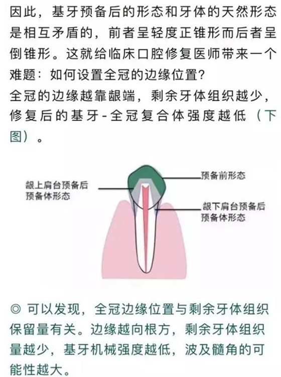 做全冠修復(fù)時基牙根面暴露，如何備牙？