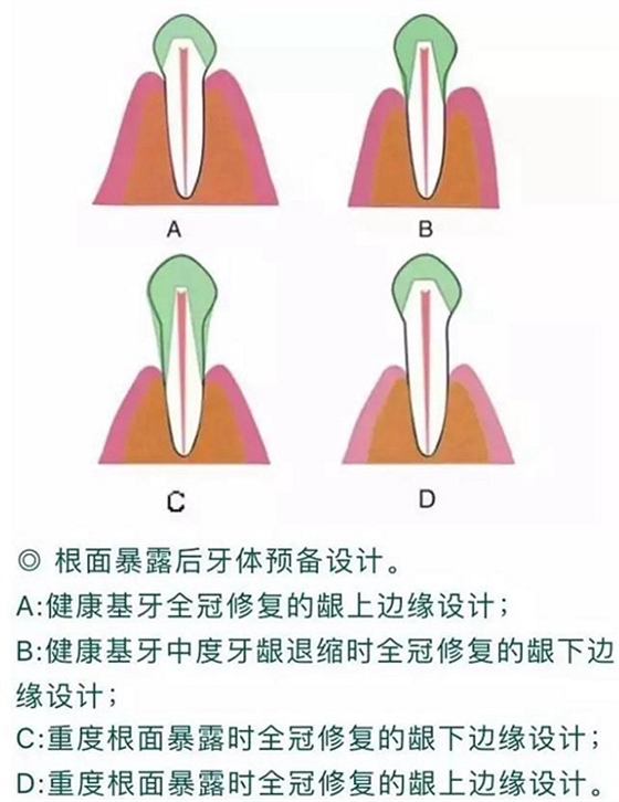 做全冠修復(fù)時基牙根面暴露，如何備牙？