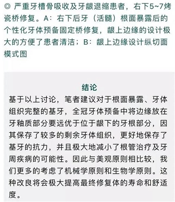 做全冠修復(fù)時基牙根面暴露，如何備牙？