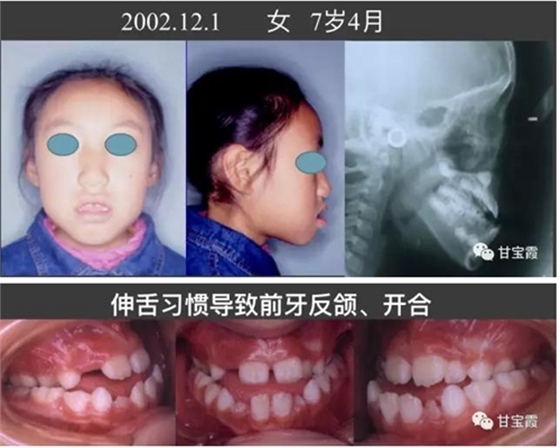 口腔不良習慣會引起牙頜畸形