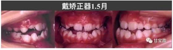 口腔不良習慣會引起牙頜畸形