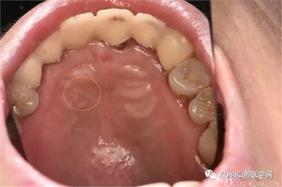 上頜側切牙根尖手術——張東星  