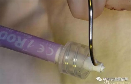 上頜側切牙根尖手術——張東星  