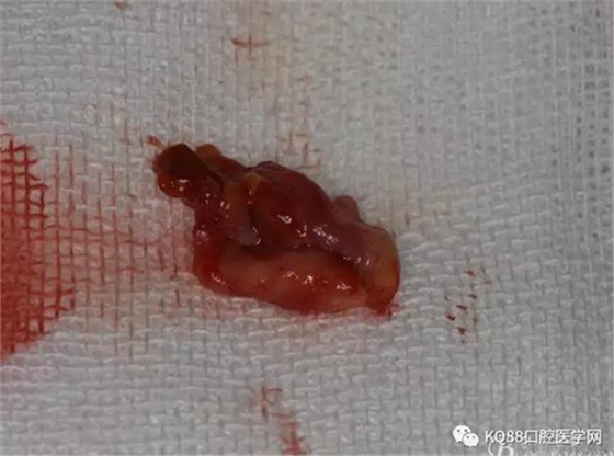 上頜側切牙根尖手術——張東星  