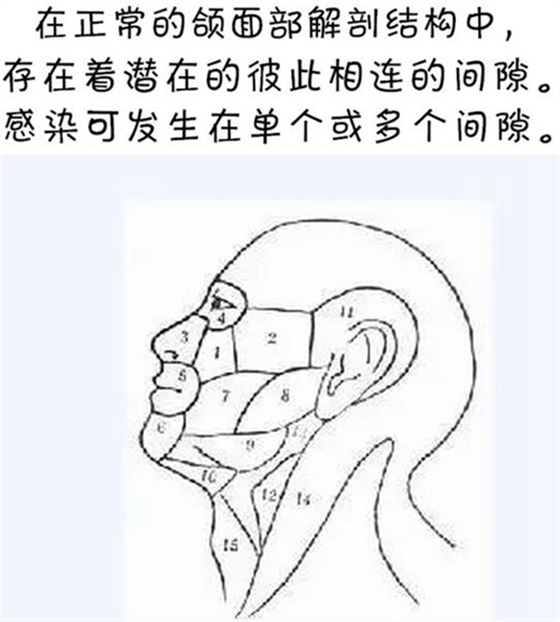 警惕！牙疼引發的間隙感染很危險