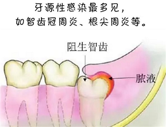 警惕！牙疼引發的間隙感染很危險