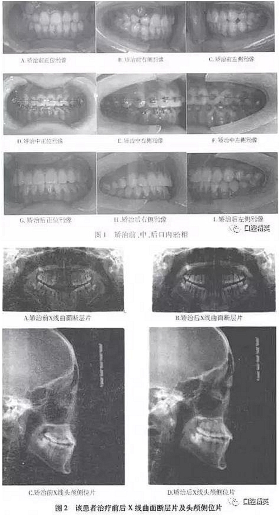 尖牙完全唇側(cè)錯(cuò)位擁擠，矯正1例  