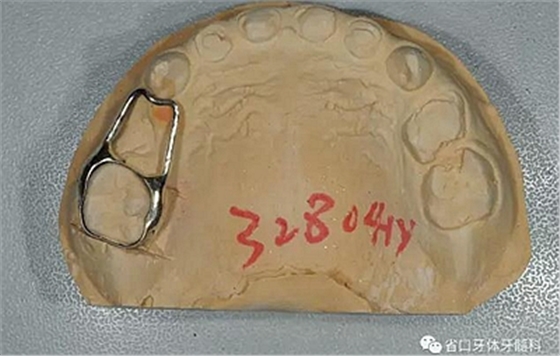 【牙醫(yī)學堂】間隙保持器的介紹  