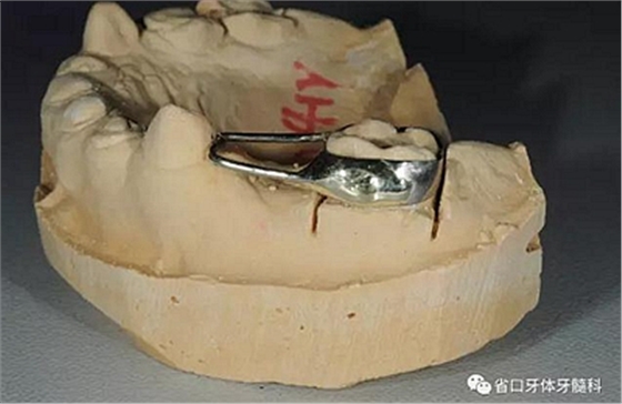 【牙醫(yī)學堂】間隙保持器的介紹  