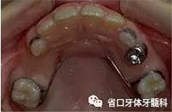 【牙醫(yī)學堂】間隙保持器的介紹  