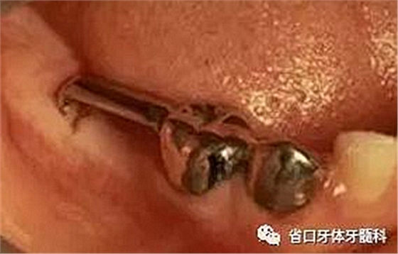 【牙醫(yī)學堂】間隙保持器的介紹  