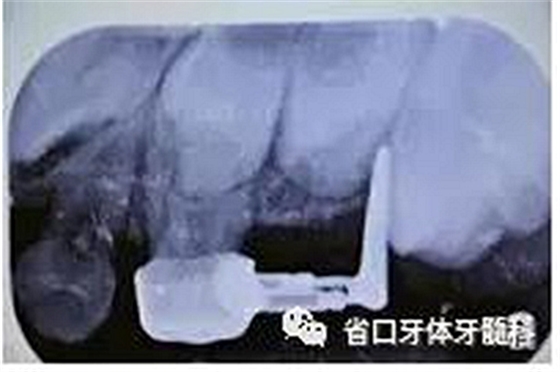 【牙醫(yī)學堂】間隙保持器的介紹  