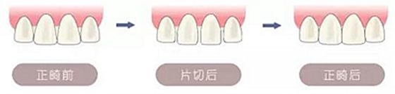 醫生方案里的鄰面去釉，究竟是什么？