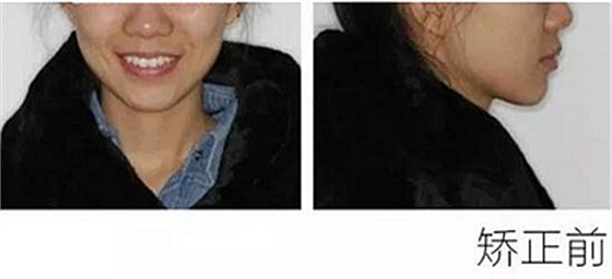 醫生方案里的鄰面去釉，究竟是什么？