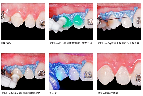 lcon愛康滲透樹脂——唇頰面齲系列應用