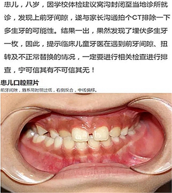 多生牙的拔除總原則：早發現，早處理！