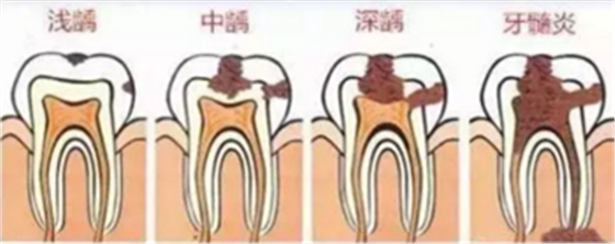 當心“腹黑”齲齒，牙齒有個小洞也要補！