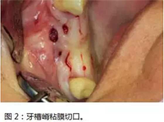 上頜竇瘺修補術——改良式旋轉帶蒂粘膜瓣修補術的應用