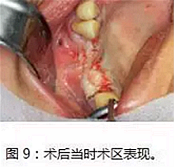 上頜竇瘺修補術——改良式旋轉帶蒂粘膜瓣修補術的應用